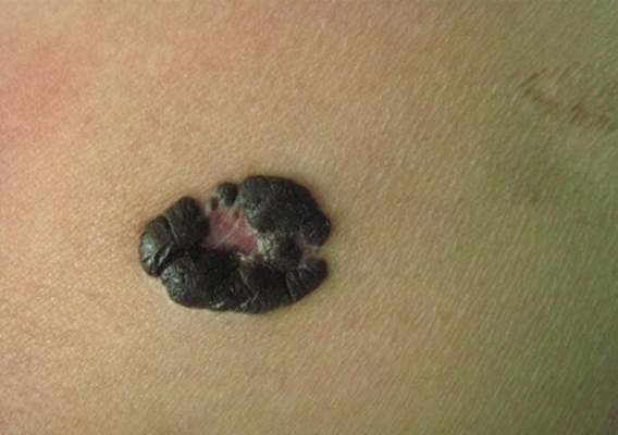 黑色素肿瘤的外观图片