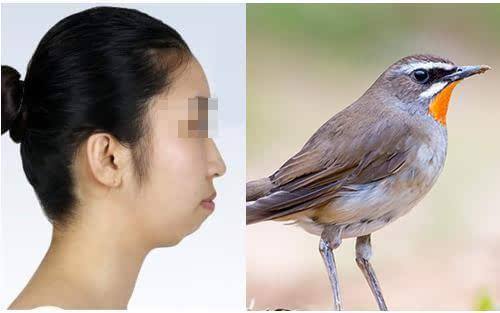 鸟脸畸形综合症图片