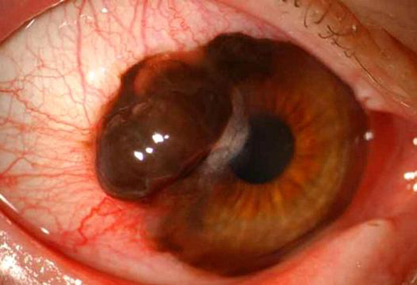 眼癌的早期症状图片图片