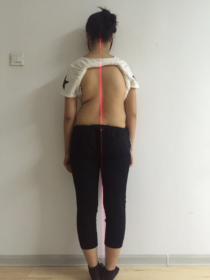 胸椎侧弯 (9)