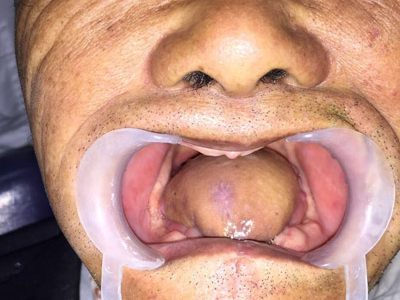 舌癌的中期症状图片图片