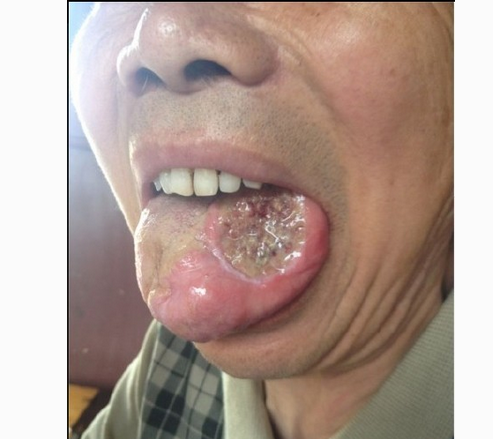 轻微舌癌图片50