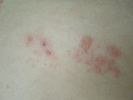 带状性疱疹初期症状图片