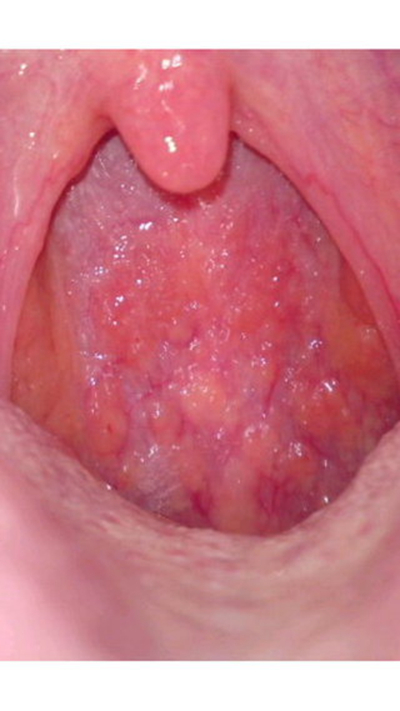 喉癌图片 (20)