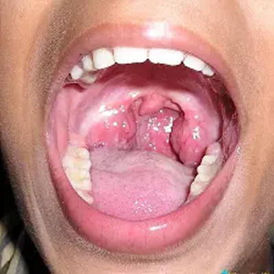 喉癌图片 (18)