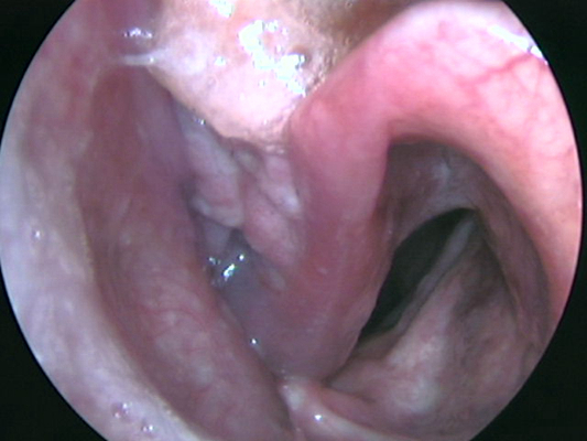喉癌图片 (28)