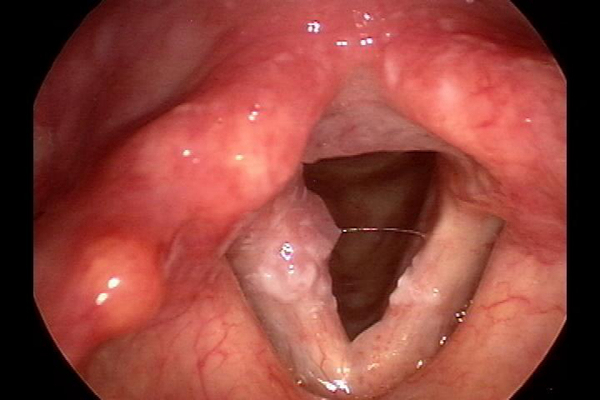喉癌图片 (36)
