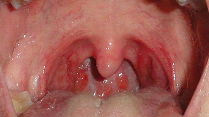 喉癌图片 (33)