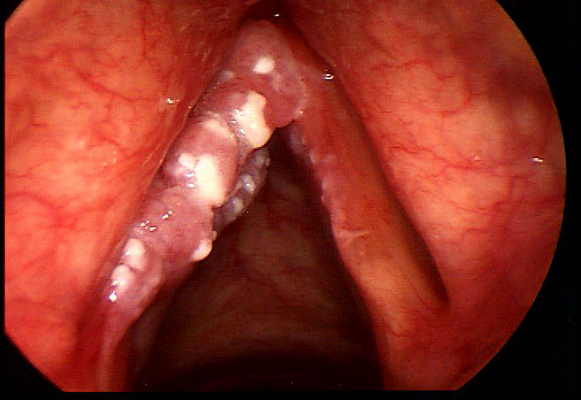 喉癌图片 (5)