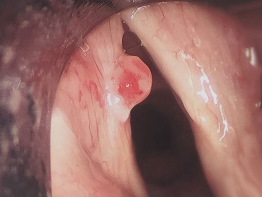 喉癌图片 (8)