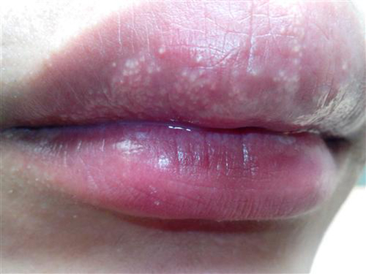 口唇炎是什么症状图片