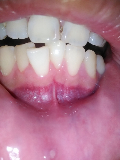牙龈癌图片 早期 表现图片
