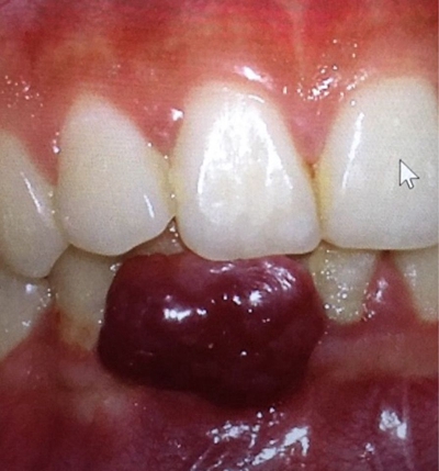 牙龈血管瘤图片