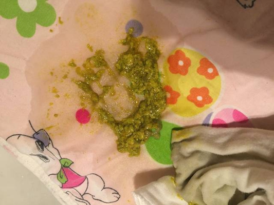 嬰兒腸炎大便圖片 (26)_有來醫生