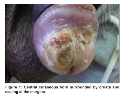 龟头霉菌感染症状图片图片
