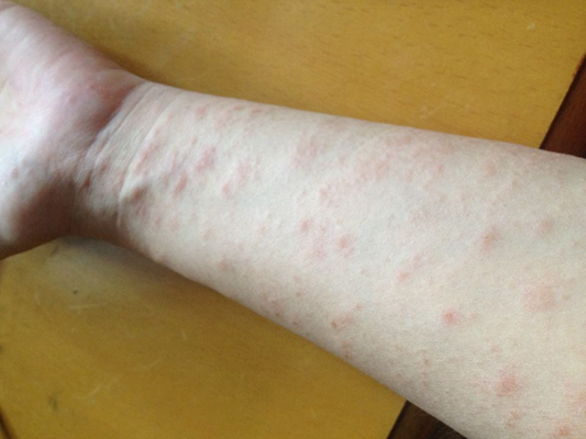 干燥性湿疹症状图片图片