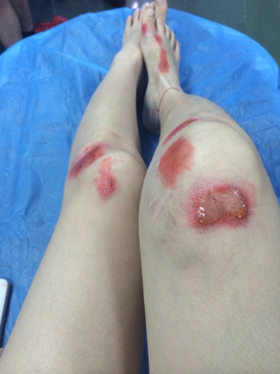 女生腿伤口图片图片
