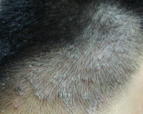 花斑癣症状头皮图片