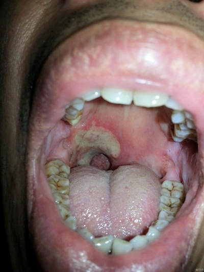嘴巴里面溃疡图片49
