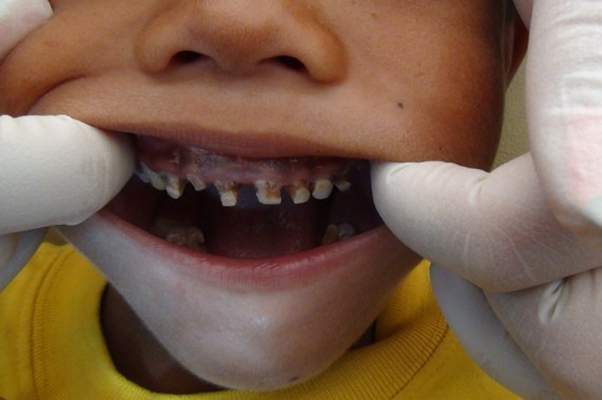 儿童牙齿发黑龋齿图片43
