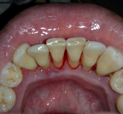 牙周袋 (12)