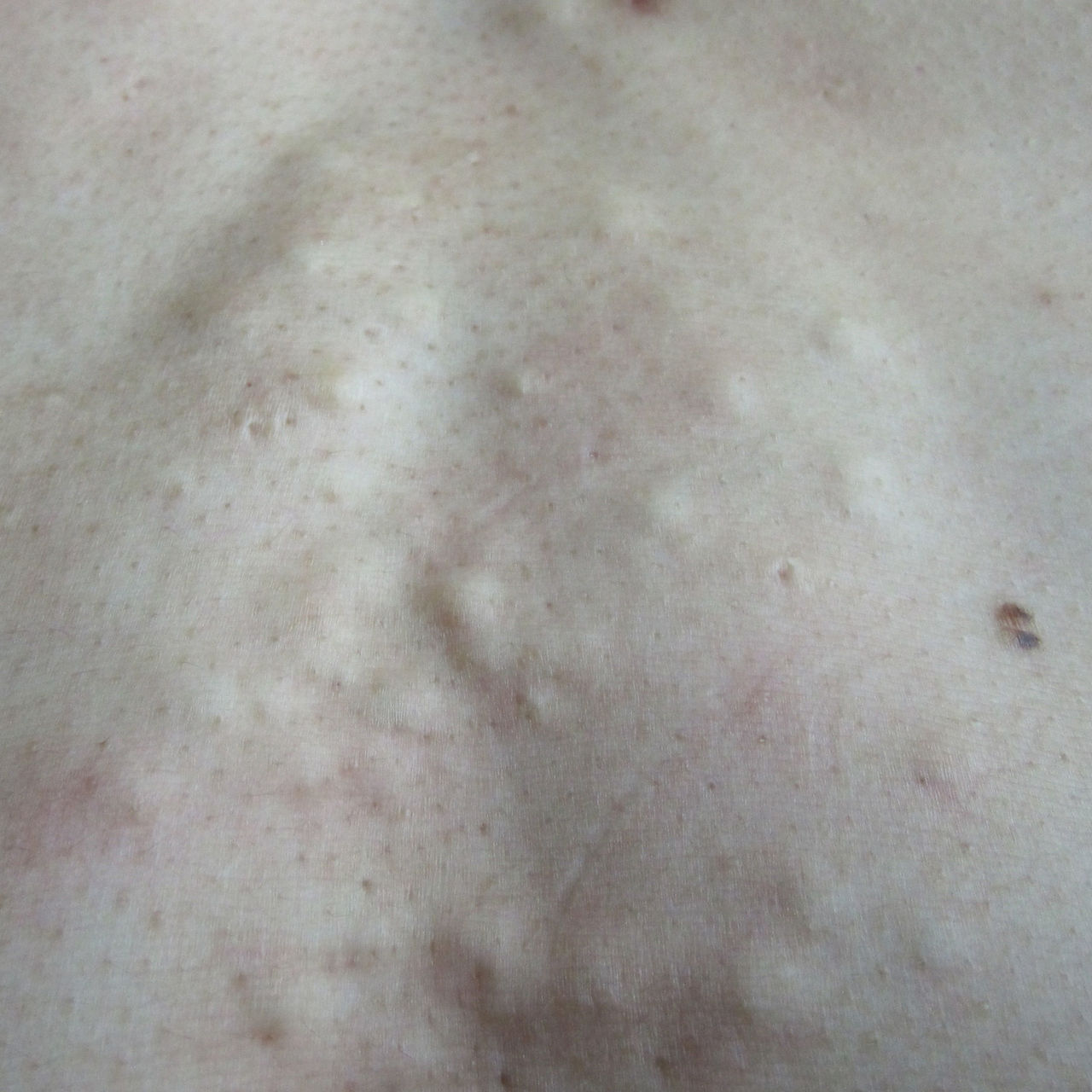 皮肤里脂肪瘤早期图片图片