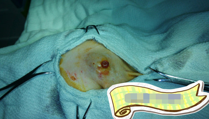 皮下脂肪瘤图片 (6)