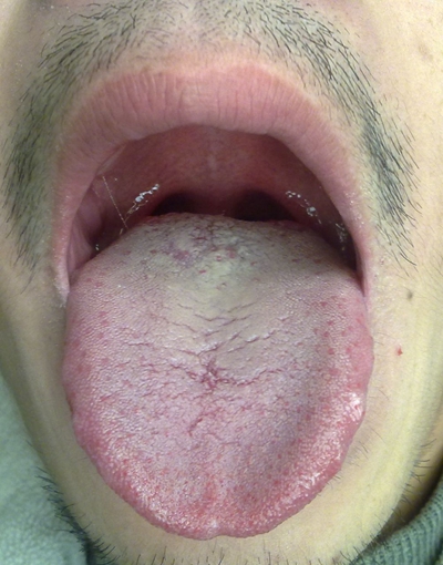 口腔白斑晚期图片