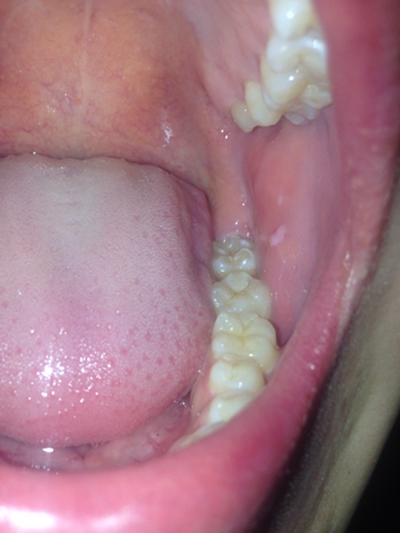 口腔内侧黏膜发白图片图片