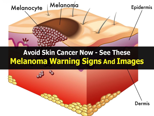 皮肤癌早期症状 (3)