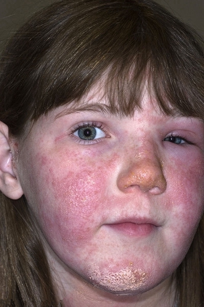 儿童皮肤热毒症状图片图片