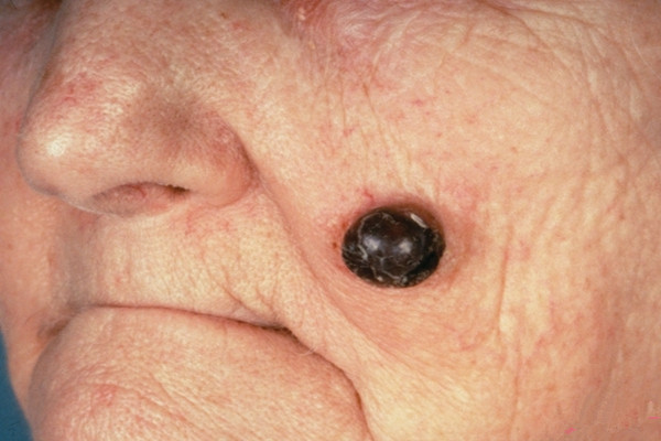 恶性痣黑色素瘤图片