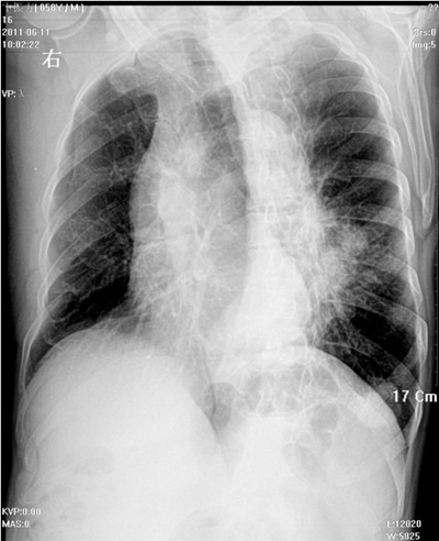 胸骨骨折x光高清图片图片