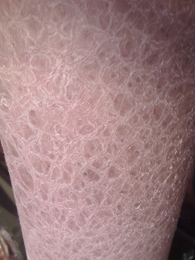 鱼鳞皮肤病 (42)