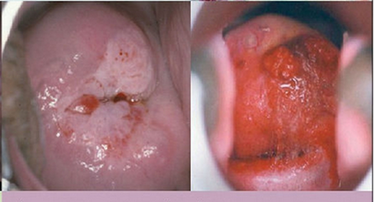 宫颈癌的早期症状图片 (41)