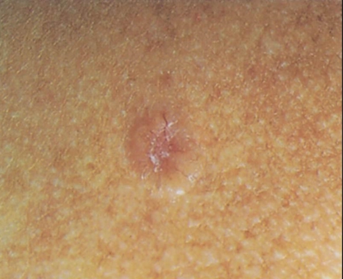 皮肤癌早期症状 (29)