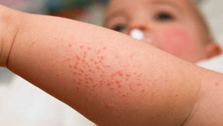 幼儿麻疹的症状图片图片