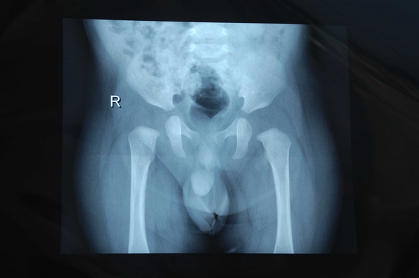 先天性髋关节脱位 (1)