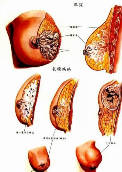 乳腺癌