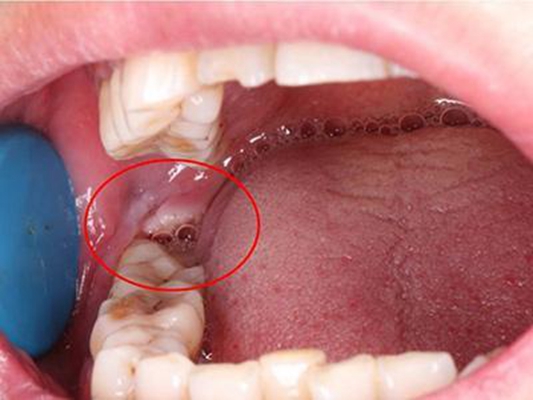 长智齿前期的症状图片图片