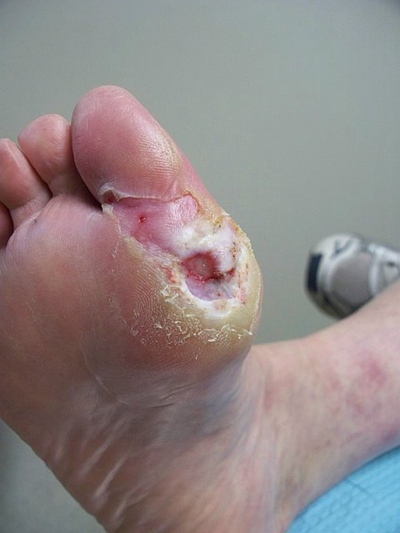 糖尿病人的脚烂的图片图片