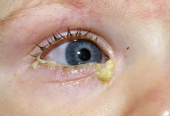 结膜炎早期症状图图片