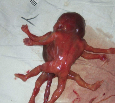 畸形胎儿图片7