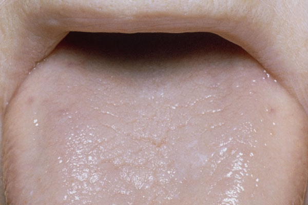 舌炎的症状图片 (15)