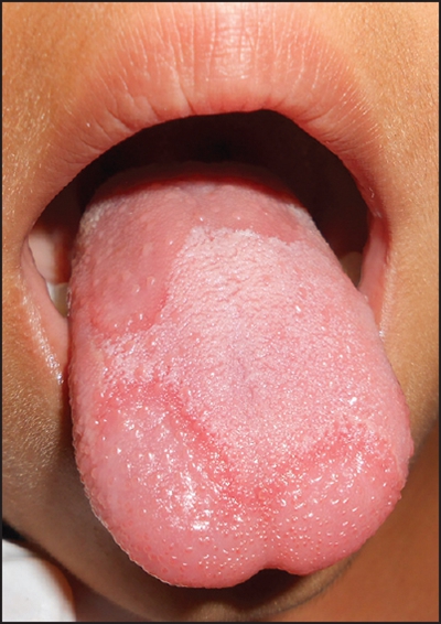 舌炎的症状图片 (12)