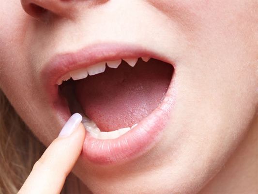 舌炎的症状图片 (4)