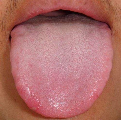 舌炎的症状图片 (50)