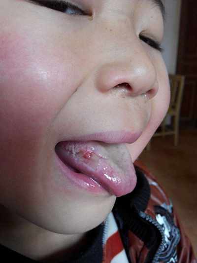 舌炎的症状图片 (48)