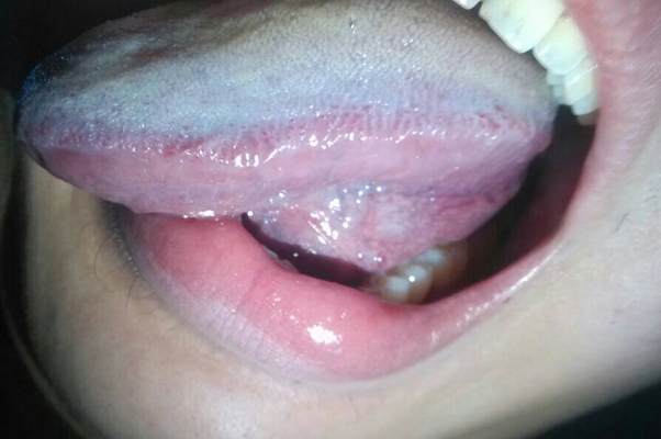 舌炎的症状图片 (8)