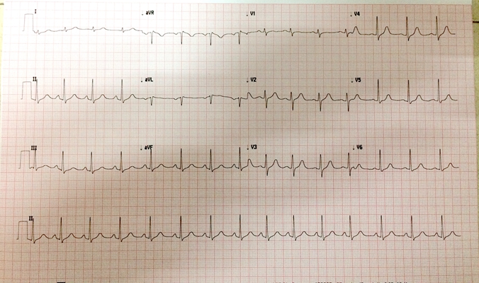 心电图异常 (8)
